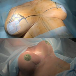 Подтяжка груди на имплантах